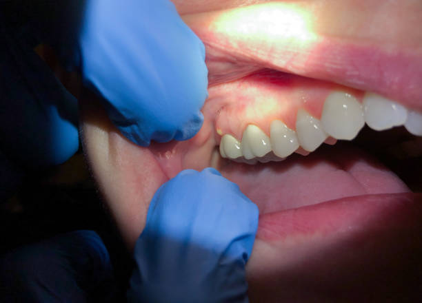 Best Emergency Treatment for Oral Infections in Harper Woods, MI